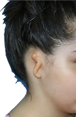 newborn with microtia